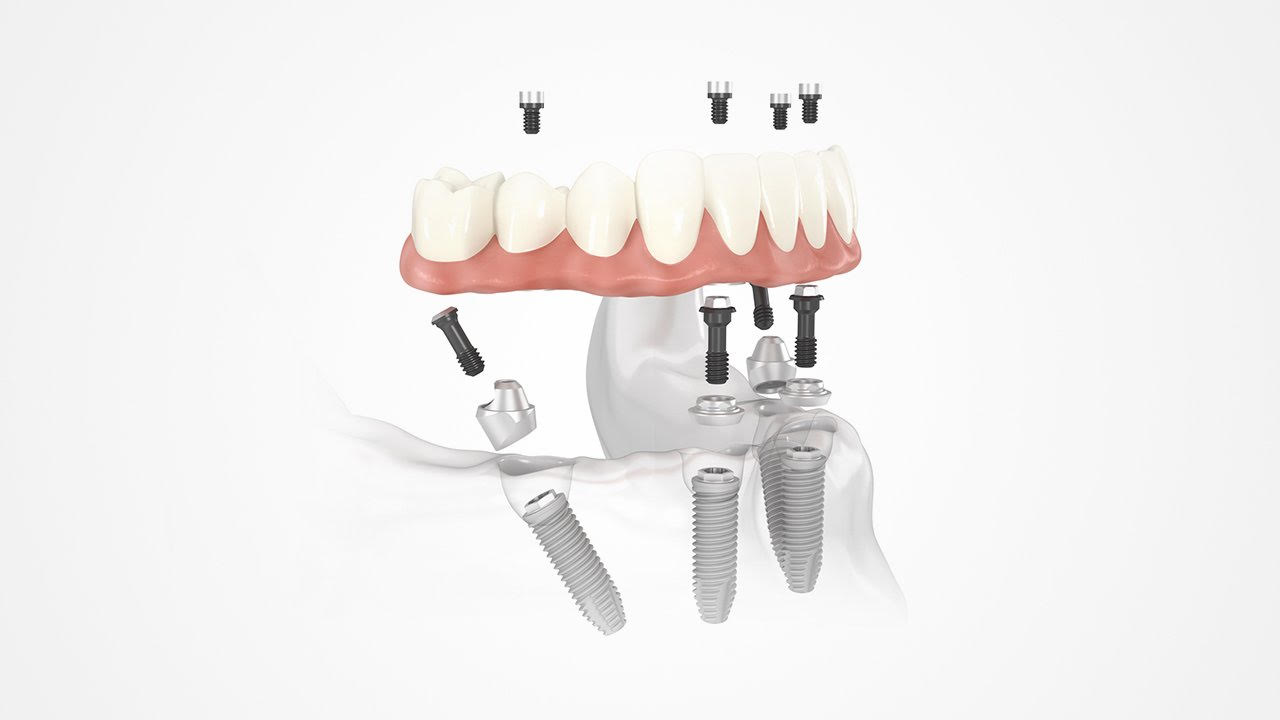What Is The All On Four Implant Technique?