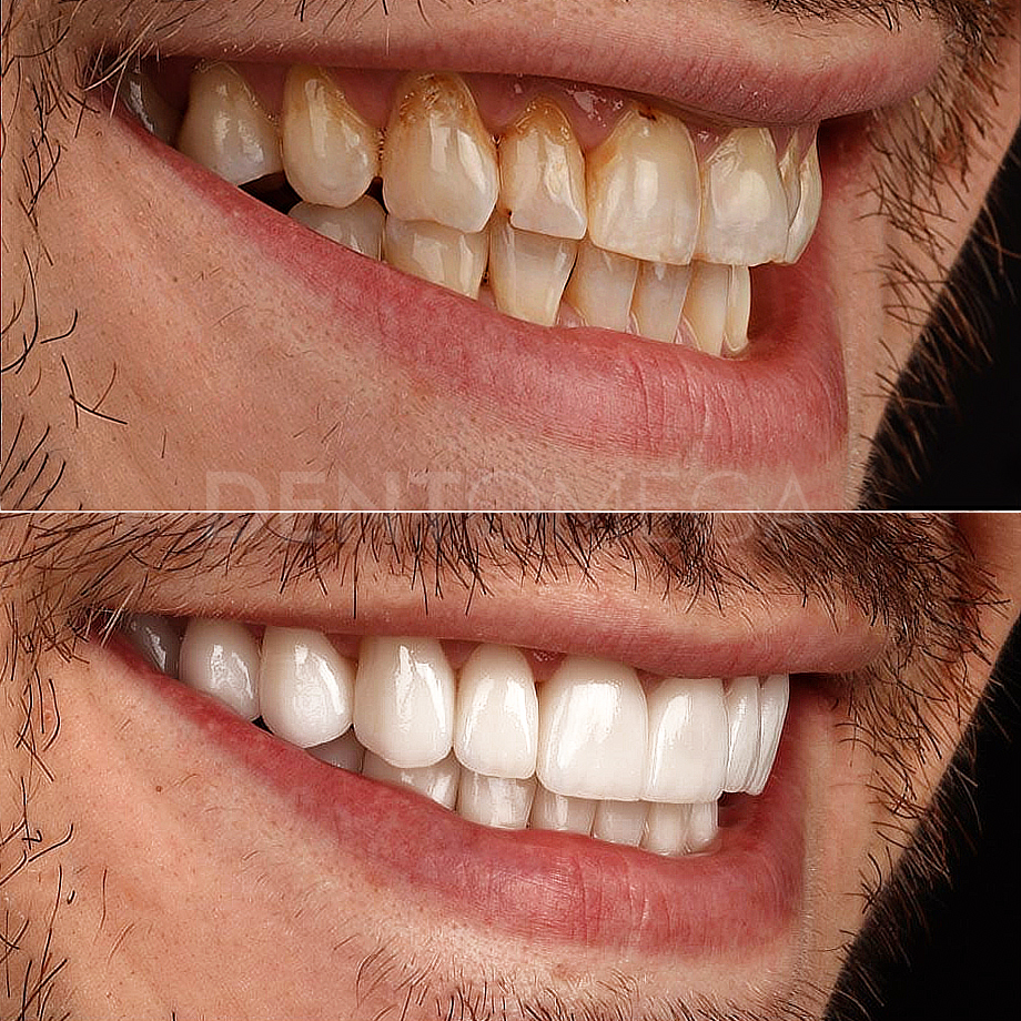 dentomega-before-afterlar2
